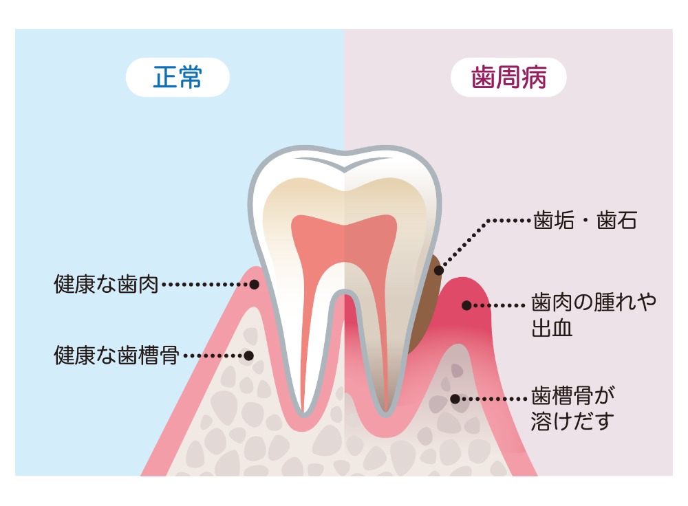 歯茎の検査